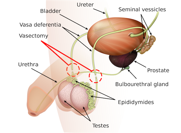 1280px-Vasectomy_diagram-en.svg